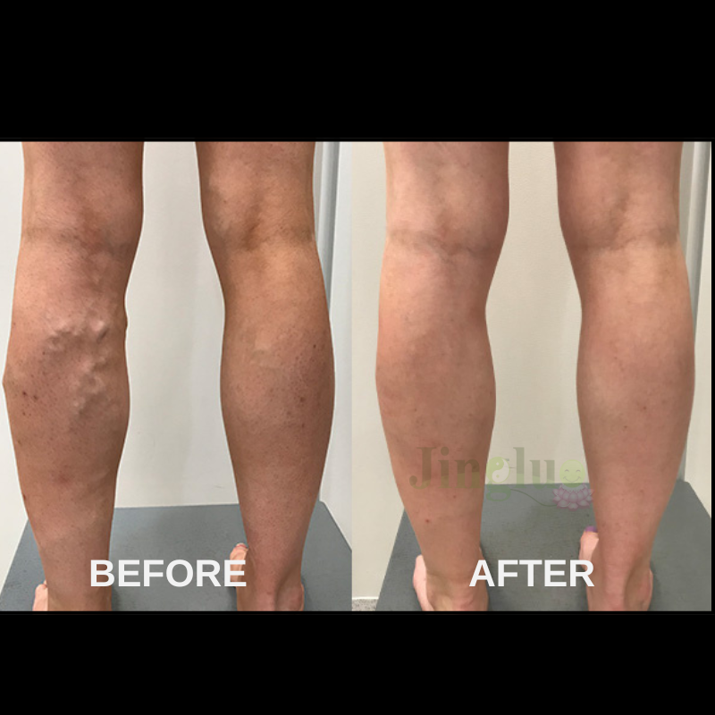 Varicose Veins Patches Mix