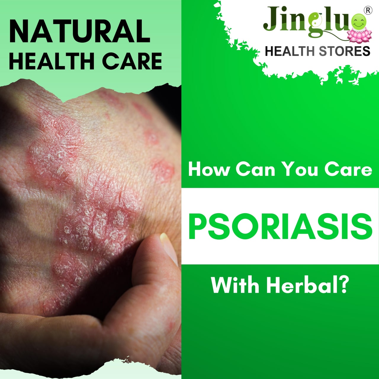 Psoriasis Relief Oil